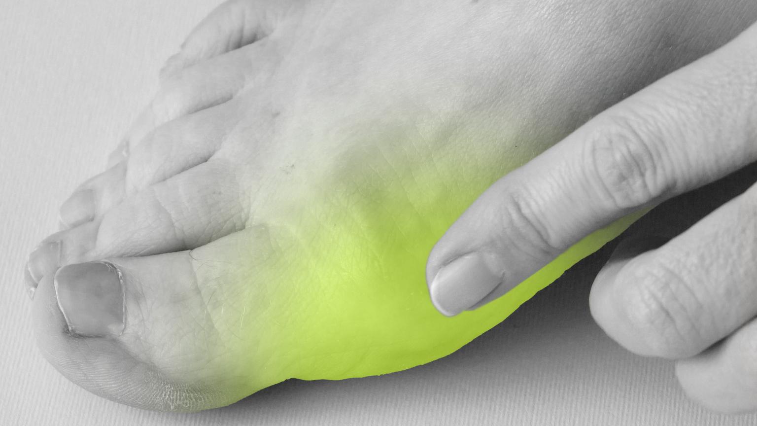 Bild von Das hilft gegen einen Hallux valgus
