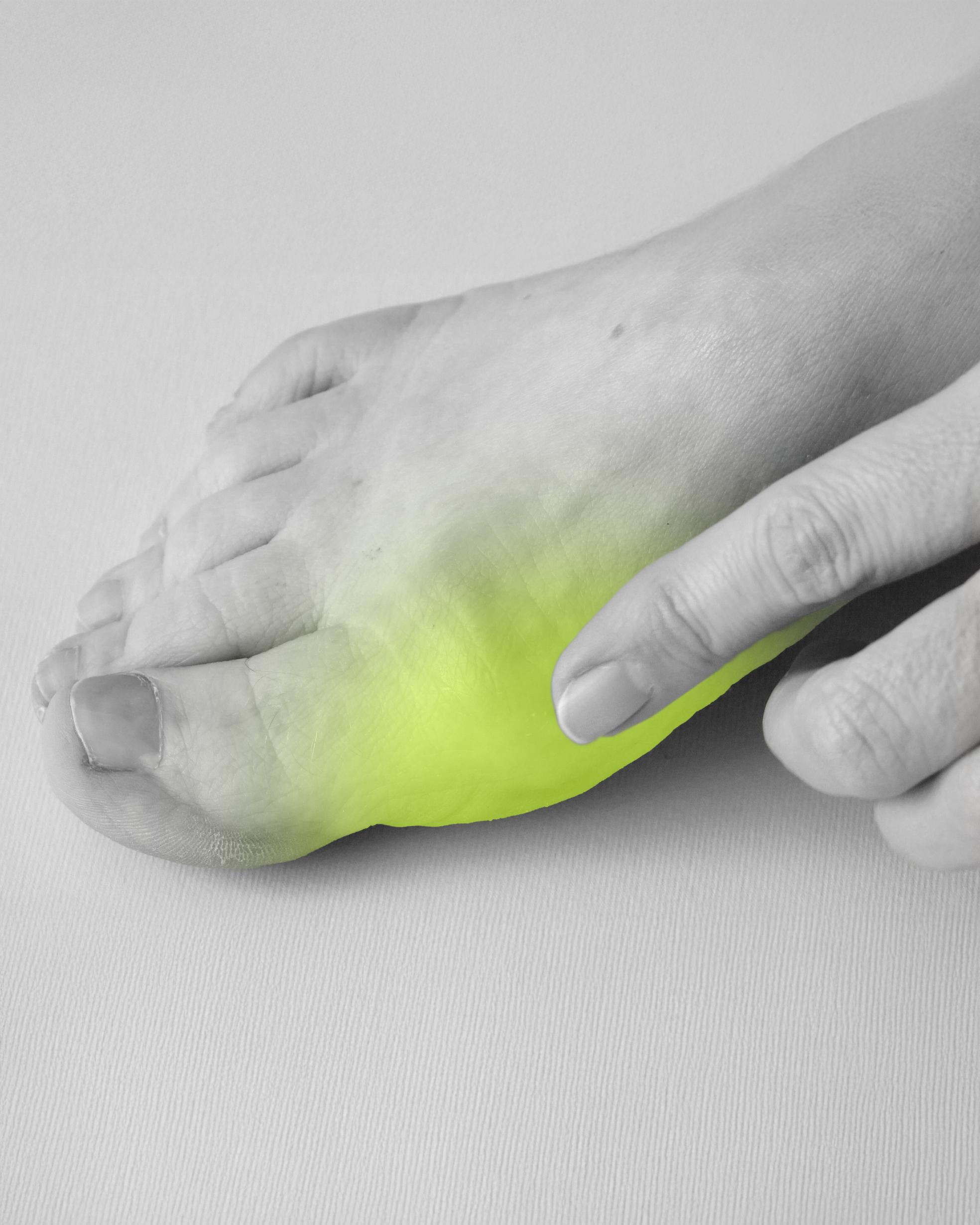 Bild von Das hilft gegen einen Hallux valgus