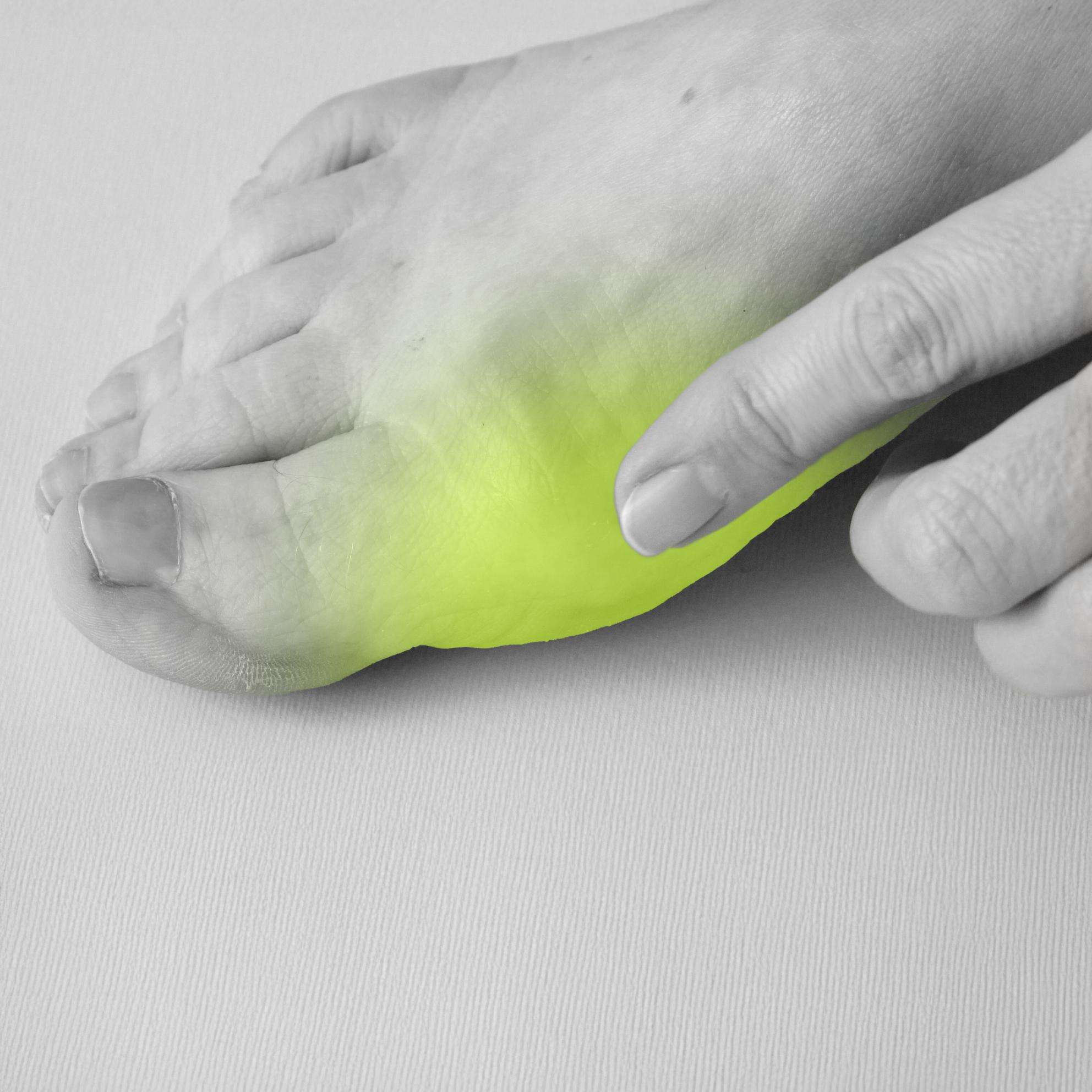 Bild von Das hilft gegen einen Hallux valgus