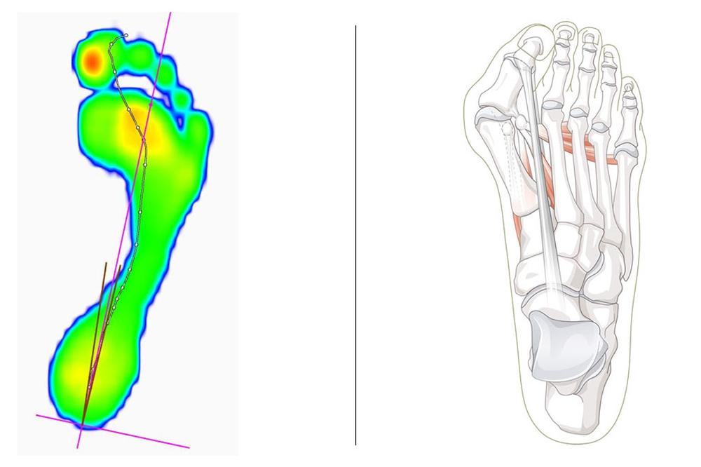 Hallux valgus: Symptome, Ursachen und Behandlung